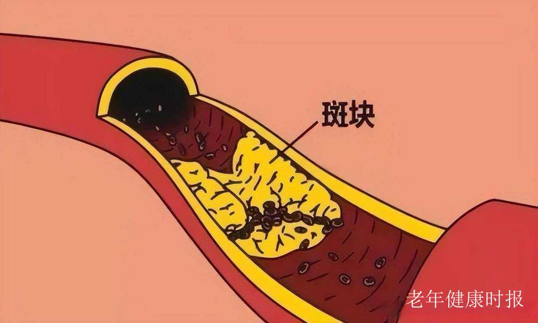 血管里的“隐形敌人”:斑块不疼不痒,危害却不小 血管里的“隐形敌人”:斑块不疼不痒,危害却不小