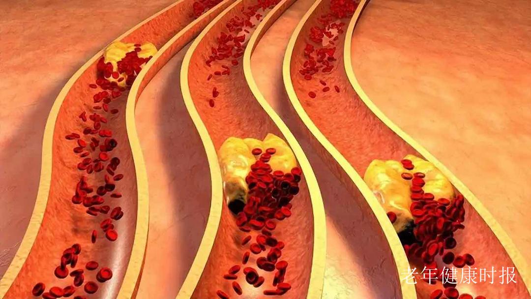 血管里的“隐形敌人”:斑块不疼不痒,危害却不小 血管里的“隐形敌人”:斑块不疼不痒,危害却不小