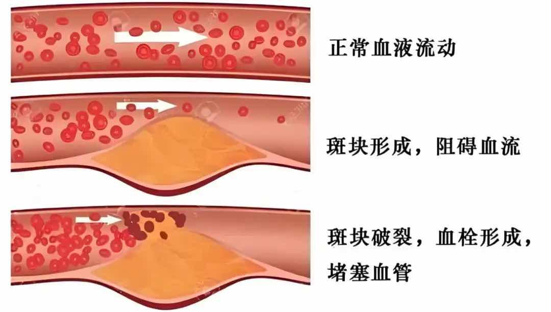 血管里的“隐形敌人”:斑块不疼不痒,危害却不小 血管里的“隐形敌人”:斑块不疼不痒,危害却不小