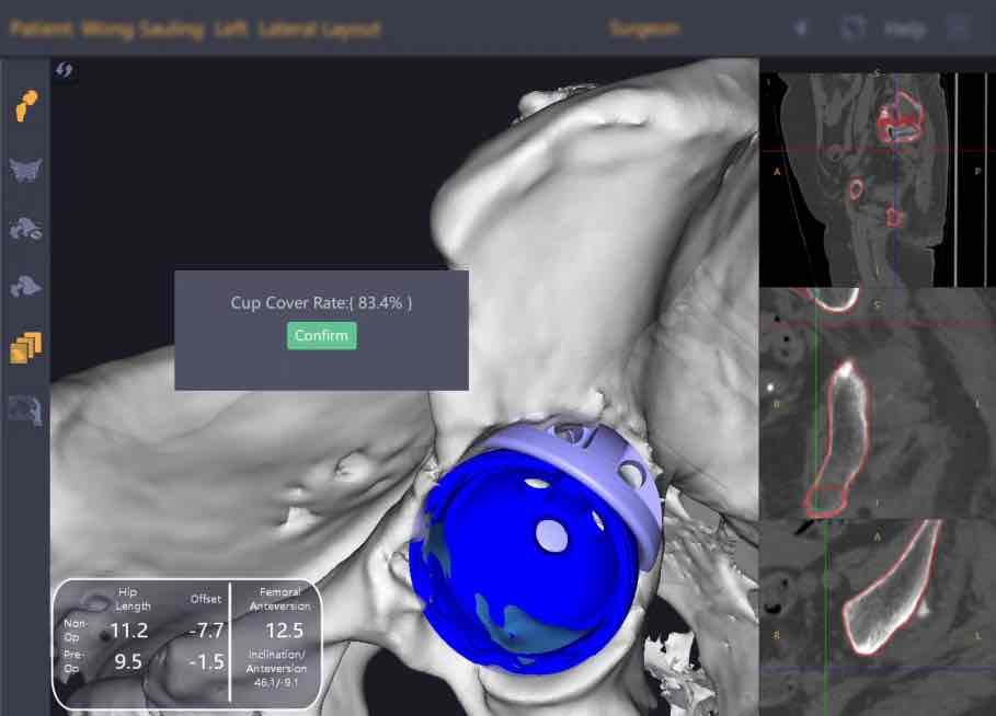 全球首例!港医疗团队借深锟铻机器人“塔积木” 重建复杂髋关 全球首例!港医疗团队借深锟铻机器人“塔积木” 重建复杂髋关
